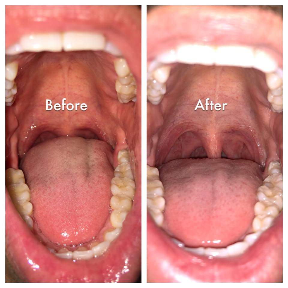 Laser Dentistry Before & After