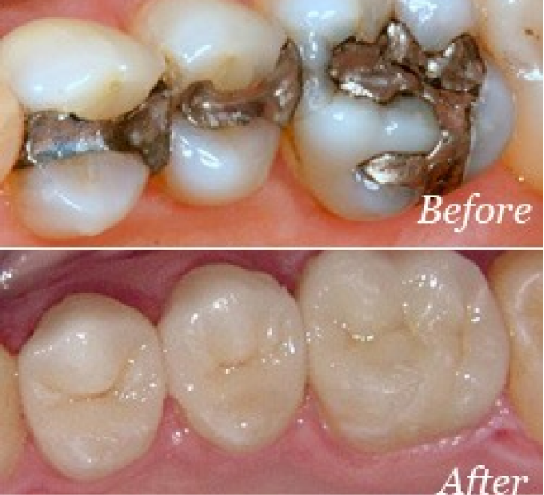 Before & After Crowns