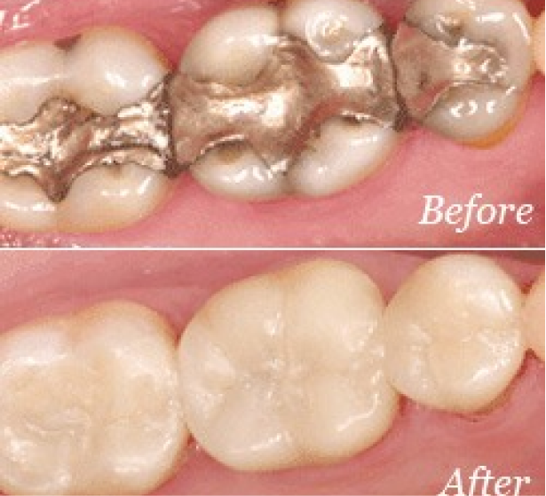 Before & After Fillings